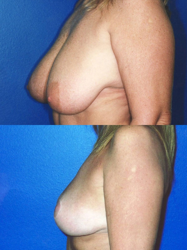 Breast reduction surgery