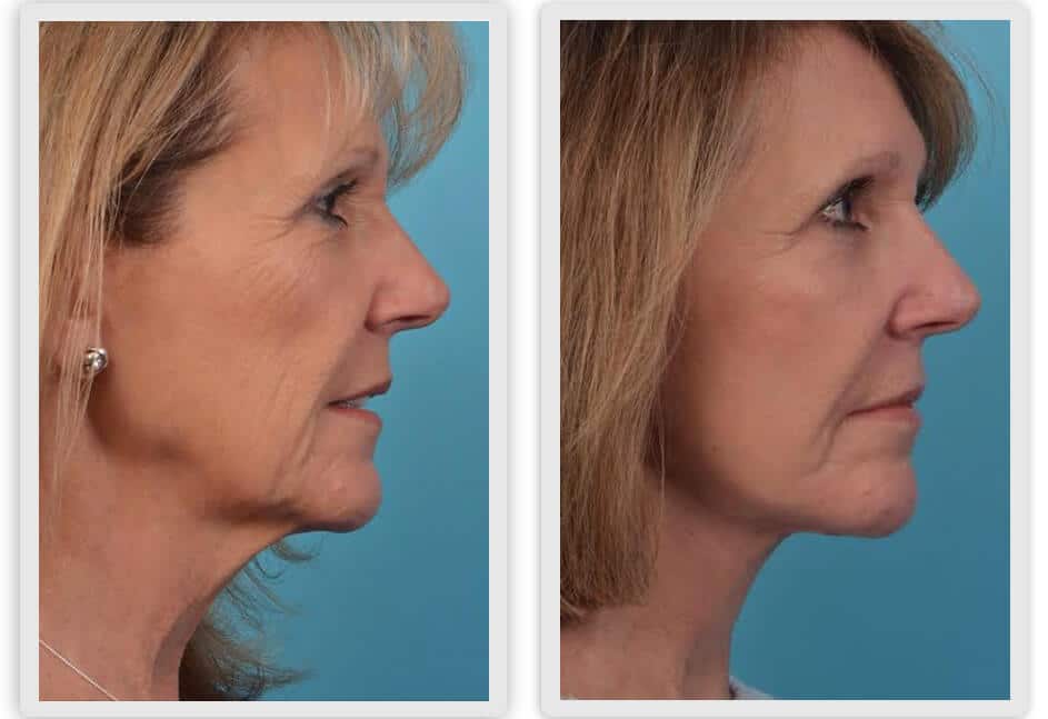 pierderea de grăsime facială înainte și după