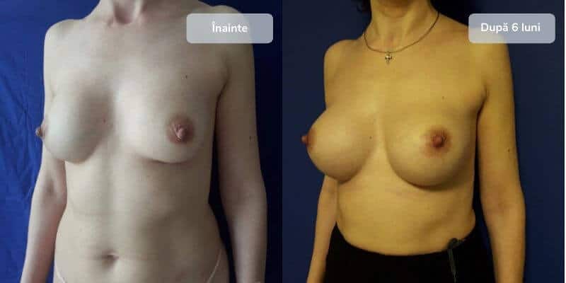 Revizie implanturi mamare - galerie foto