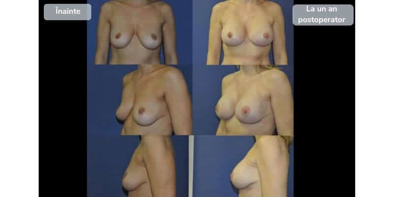 Revizie implanturi mamare - galerie foto