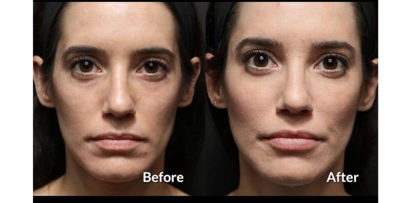 Botox din ridurile faciale inainte si dupa fotografii