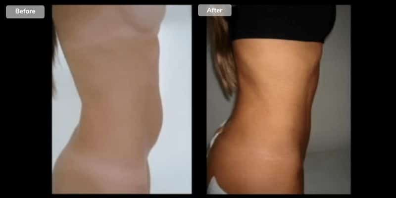 Liposuctie Before After